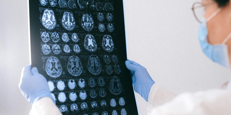 Alzheimer: femeile primesc diagnosticul cu aproape 3 ani mai târziu decât bărbații
